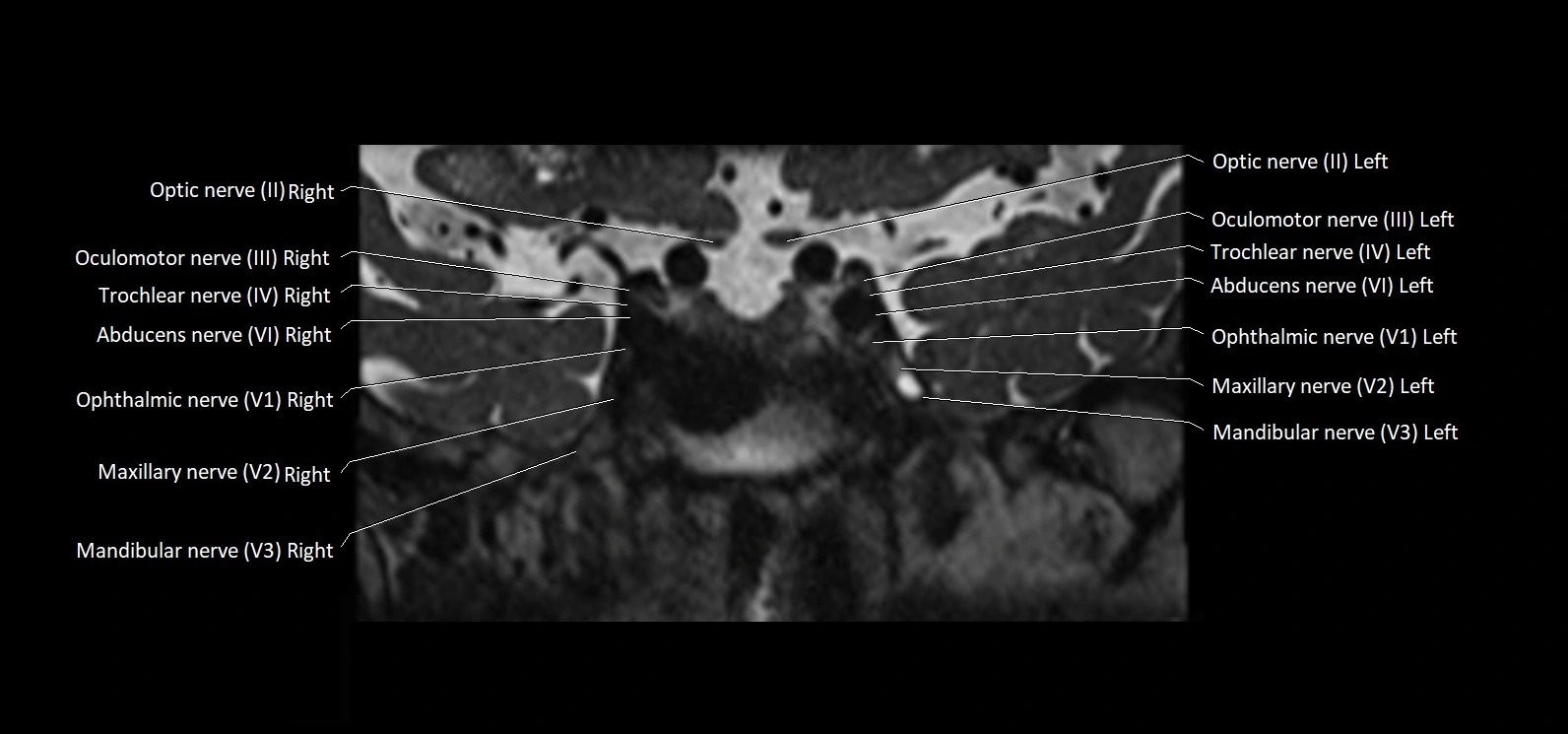 Cranial nerve cross sectional anatomy coronal 3T MRI image 26.webp
